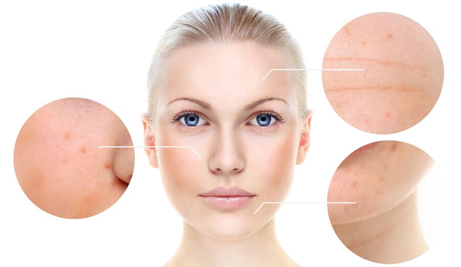 CHEMICAL PEEL